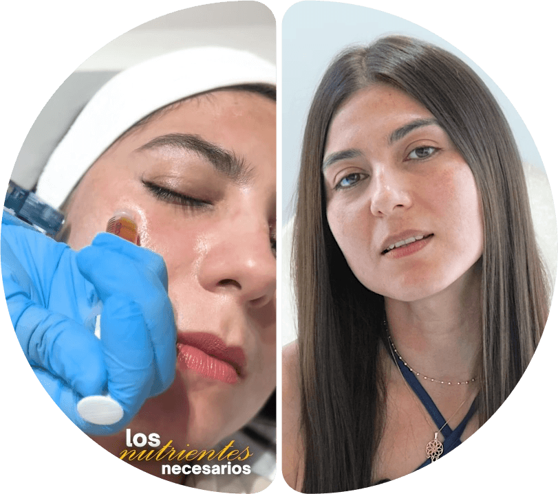 Antes y después — Revitalización y Relleno de Labios Premium